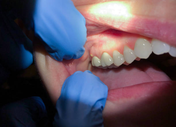 Best Emergency Wisdom Teeth Removal in Chalmette, LA